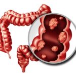 What is Colorectal Cancer