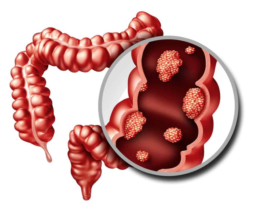 What is Colorectal Cancer