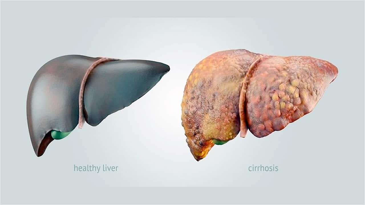 Cirrhosis of the liver