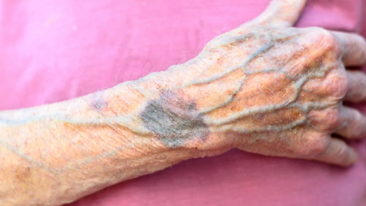 Blue veins