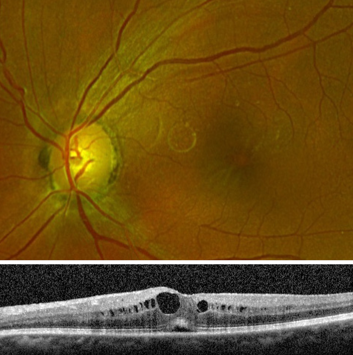 Macular Edema