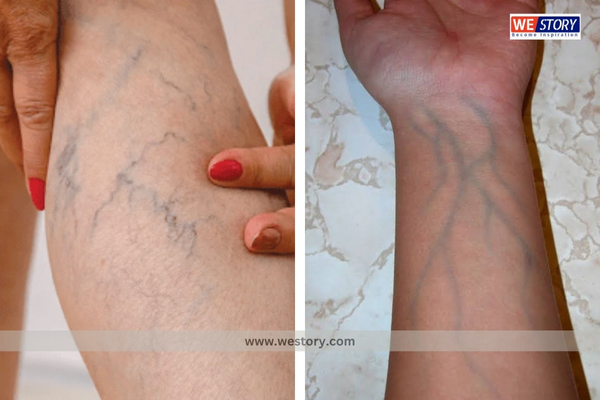 Blue veins