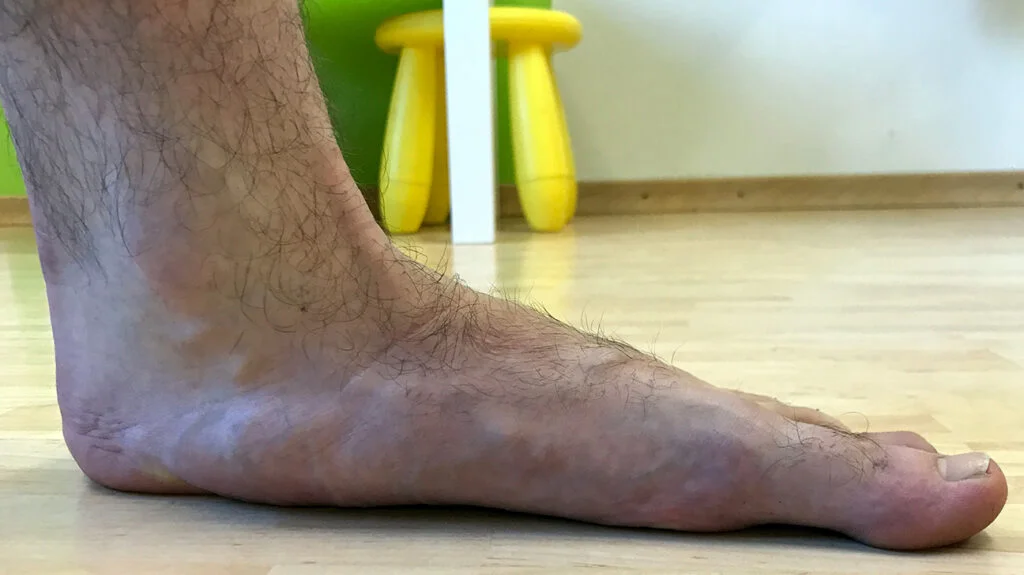 Flat Feet