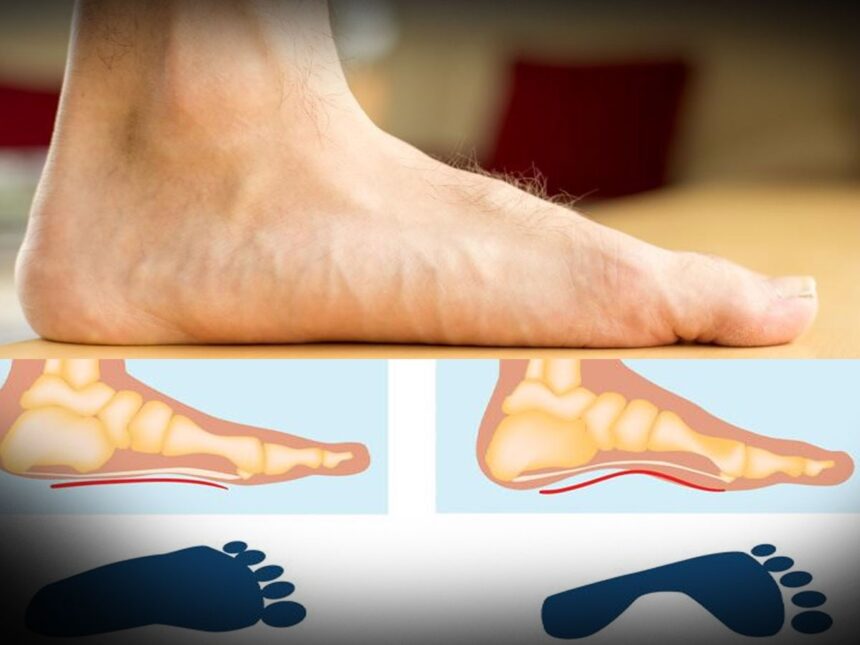 Flat Feet