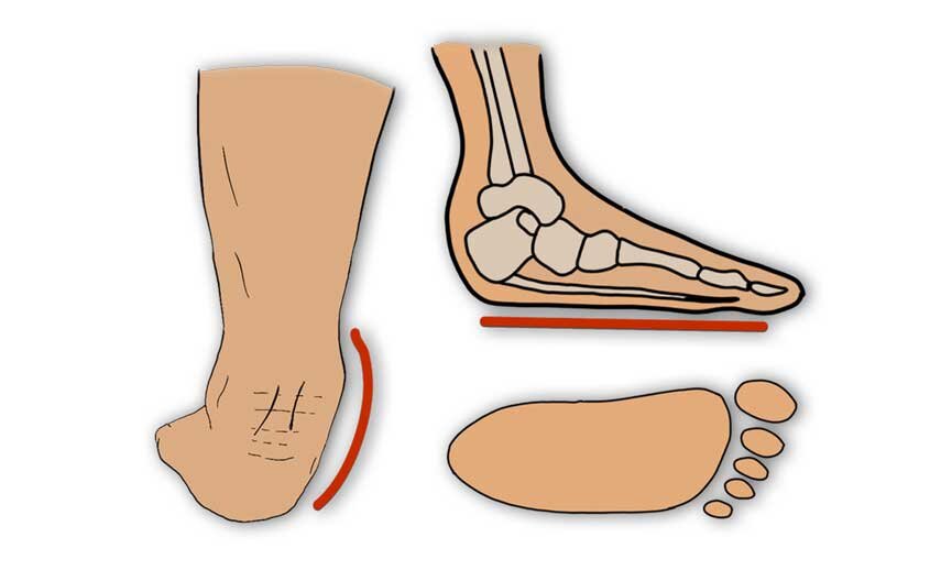 Flat Feet