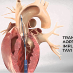 Transcatheter Aortic Valve Implantation