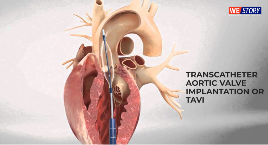 Transcatheter Aortic Valve Implantation