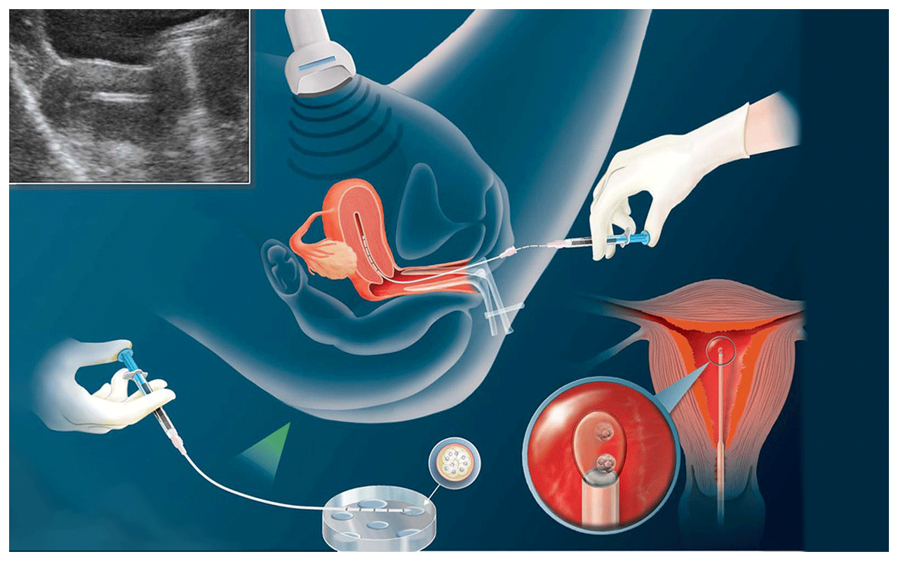 Intrauterine Insemination or IVF